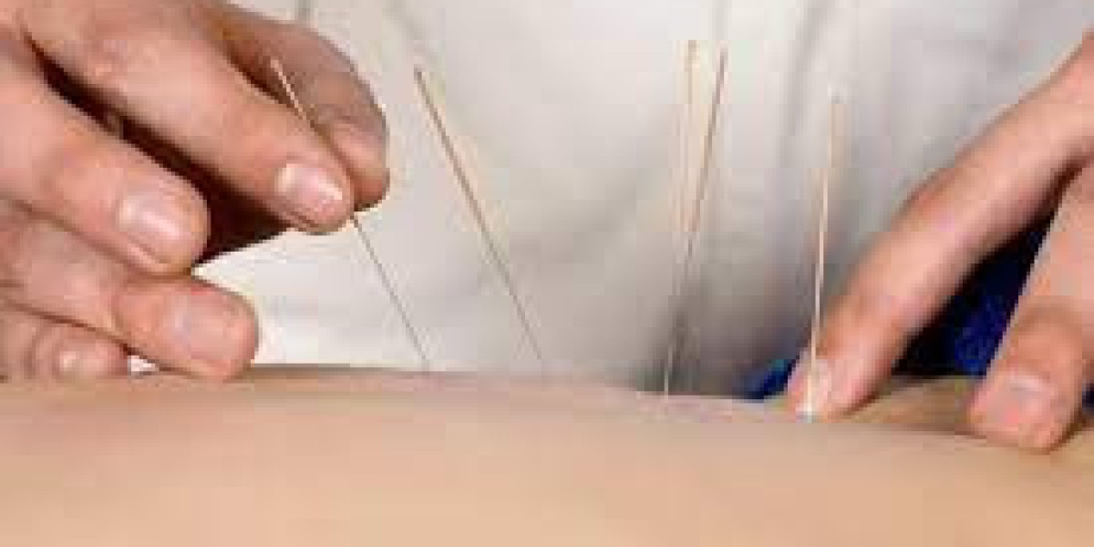 Comprehensive Dry Needling Physiotherapy in Surrey: Your Path to Recovery