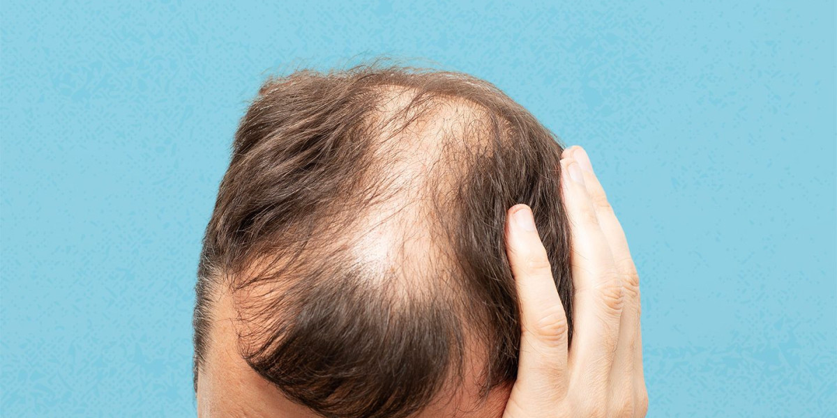 How I Found the Right Treatment for Alopecia Areata | B2BPharmahub