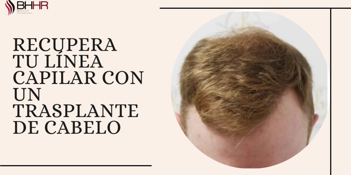 Recupera tu línea capilar con un trasplante de cabelo